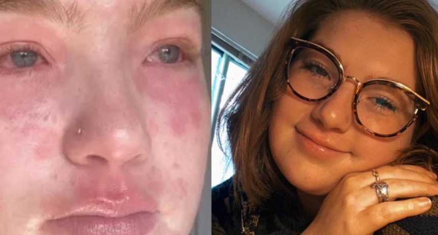 Joven dice que su novio le produce alergia