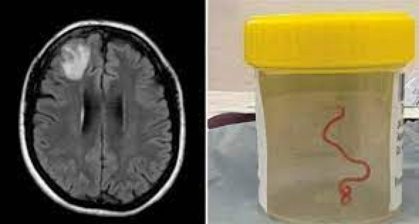 Mujer ten&iacute;a una lombriz en su cerebro