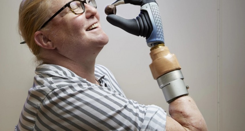 Mujer recupera movilidad gracias a mano bi&oacute;nica