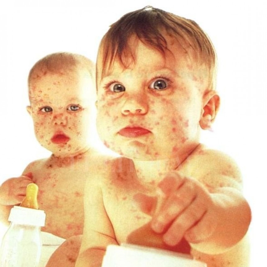 La Organizaci&oacute;n Mundial de la Salud advierte por un fuerte incremento de casos de sarampi&oacute;n